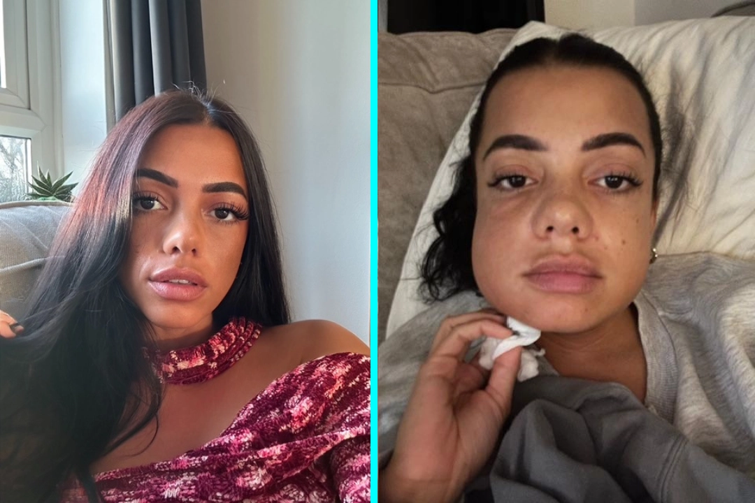 Mum left looking like Family Guy's Quagmire after wisdom teeth removal with no aftercare - Thalia George spent a week in hospital on the brink of sepsis after the surgery.
