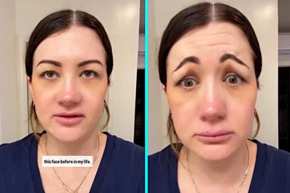 A woman says a Botox mishap left her pulling a terrifying Scream style face that scared her fiancé, went viral with millions of views and cost hundreds to fix