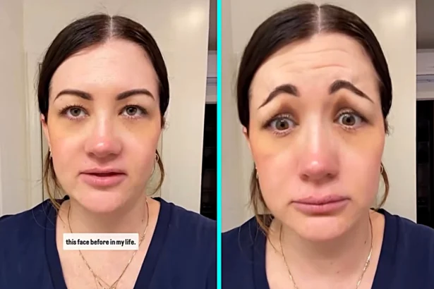 A woman says a Botox mishap left her pulling a terrifying Scream style face that scared her fiancé, went viral with millions of views and cost hundreds to fix