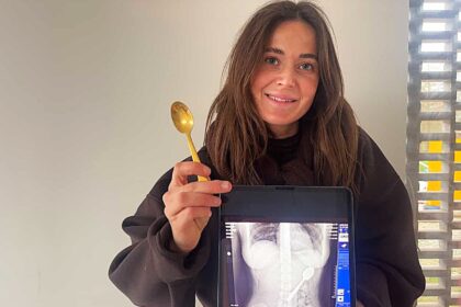 Reymy Amelinckx from Rumst, Belgium swallowed 17cm spoon when her Hungarian Vizsla Marley jumped on her lap while eating yogurt. Spoon removed via gastroscopy.