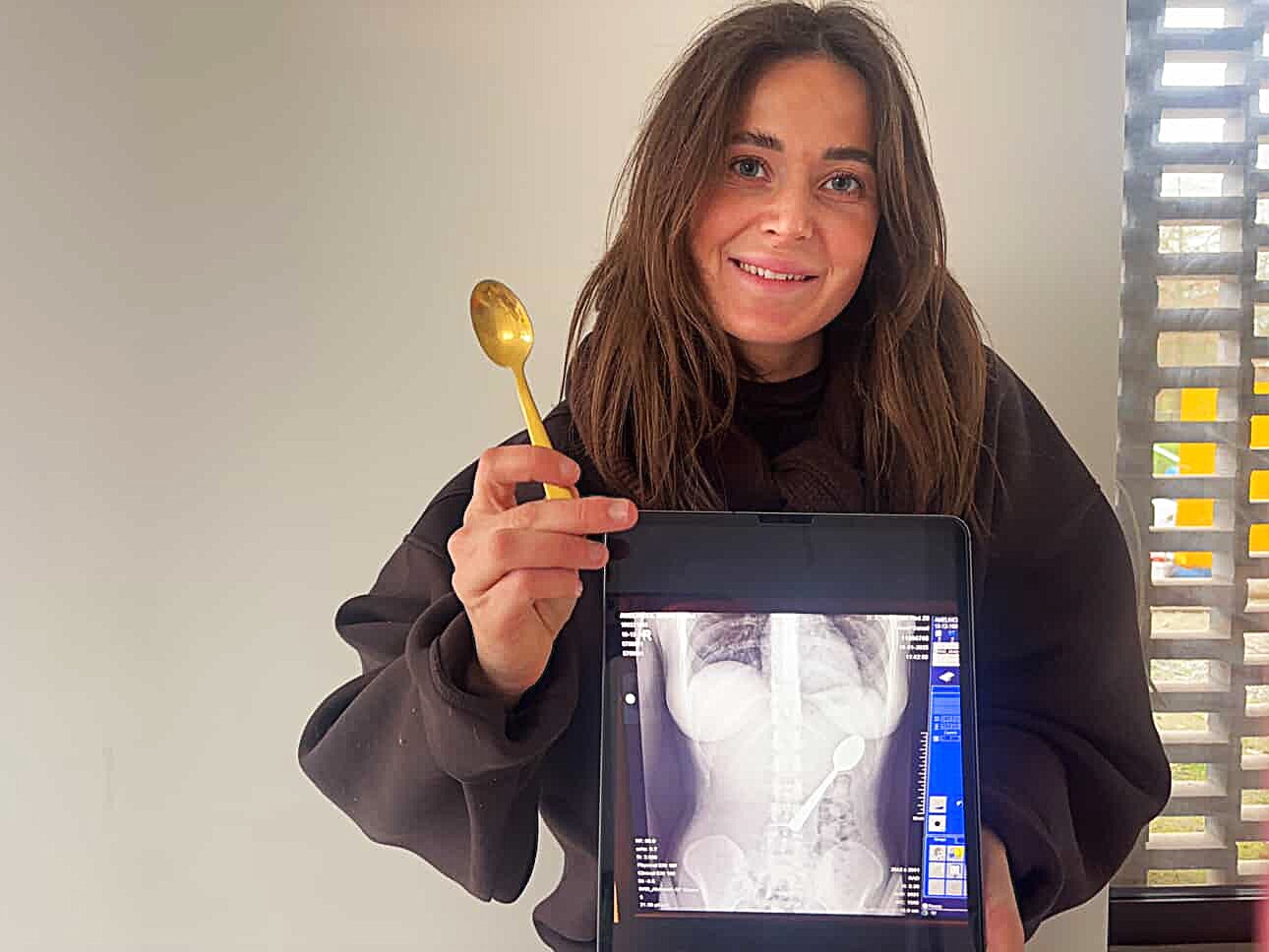 Reymy Amelinckx from Rumst, Belgium swallowed 17cm spoon when her Hungarian Vizsla Marley jumped on her lap while eating yogurt. Spoon removed via gastroscopy.