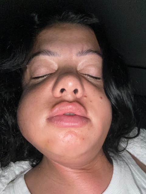 Mum left looking like Family Guy's Quagmire after wisdom teeth removal with no aftercare - Thalia George spent a week in hospital on the brink of sepsis after the surgery.