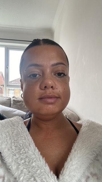 Mum left looking like Family Guy's Quagmire after wisdom teeth removal with no aftercare - Thalia George spent a week in hospital on the brink of sepsis after the surgery.