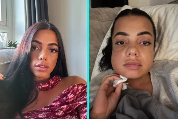 Mum left looking like Family Guy's Quagmire after wisdom teeth removal with no aftercare - Thalia George spent a week in hospital on the brink of sepsis after the surgery.