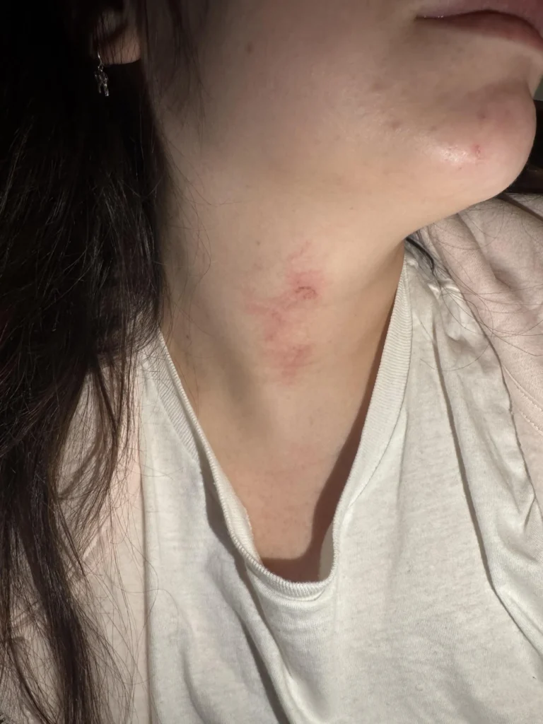 Woman’s dream move to Amsterdam turns nightmare after shocking accidents and surgery force her home. Her emotional recovery journey reveals resilience and hope.