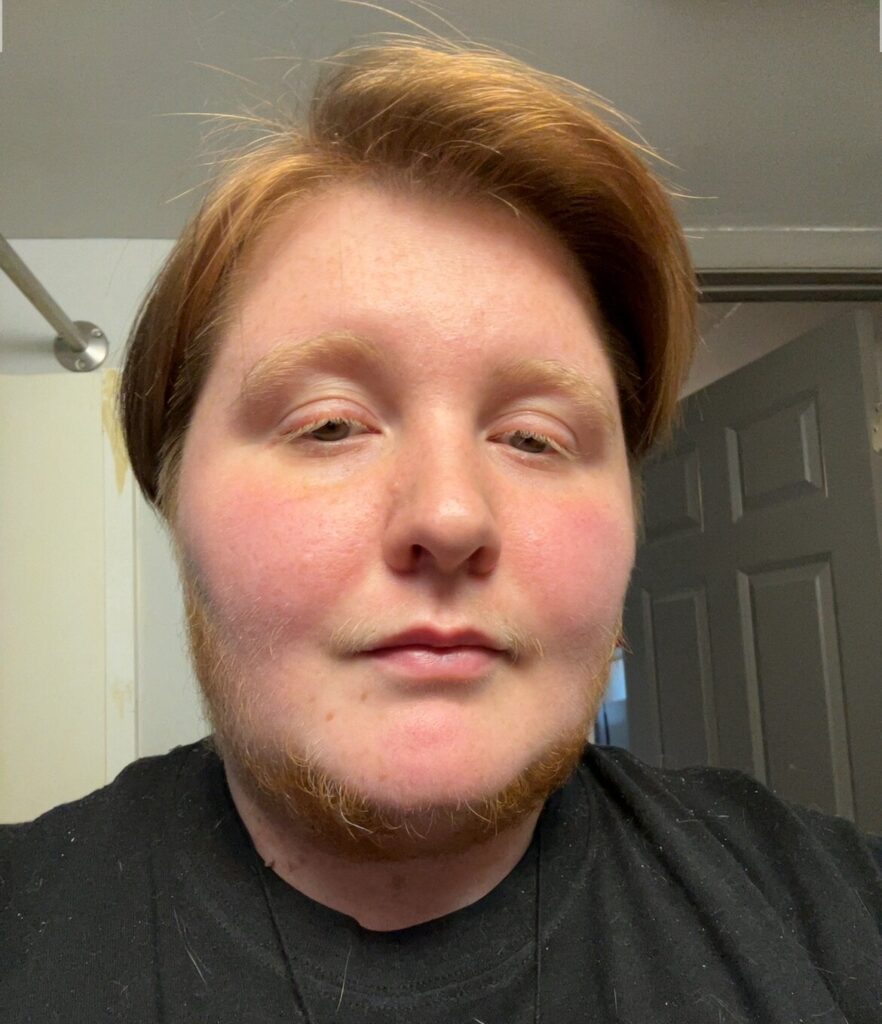 A woman with hirsutism proudly embraces her full neck beard despite cruel comments from strangers and exes who called it disgusting - saying she feels more beautiful and whole.