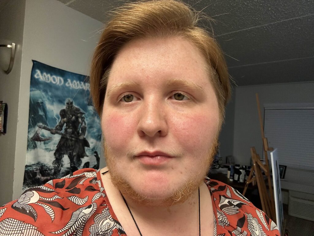 A woman with hirsutism proudly embraces her full neck beard despite cruel comments from strangers and exes who called it disgusting - saying she feels more beautiful and whole.