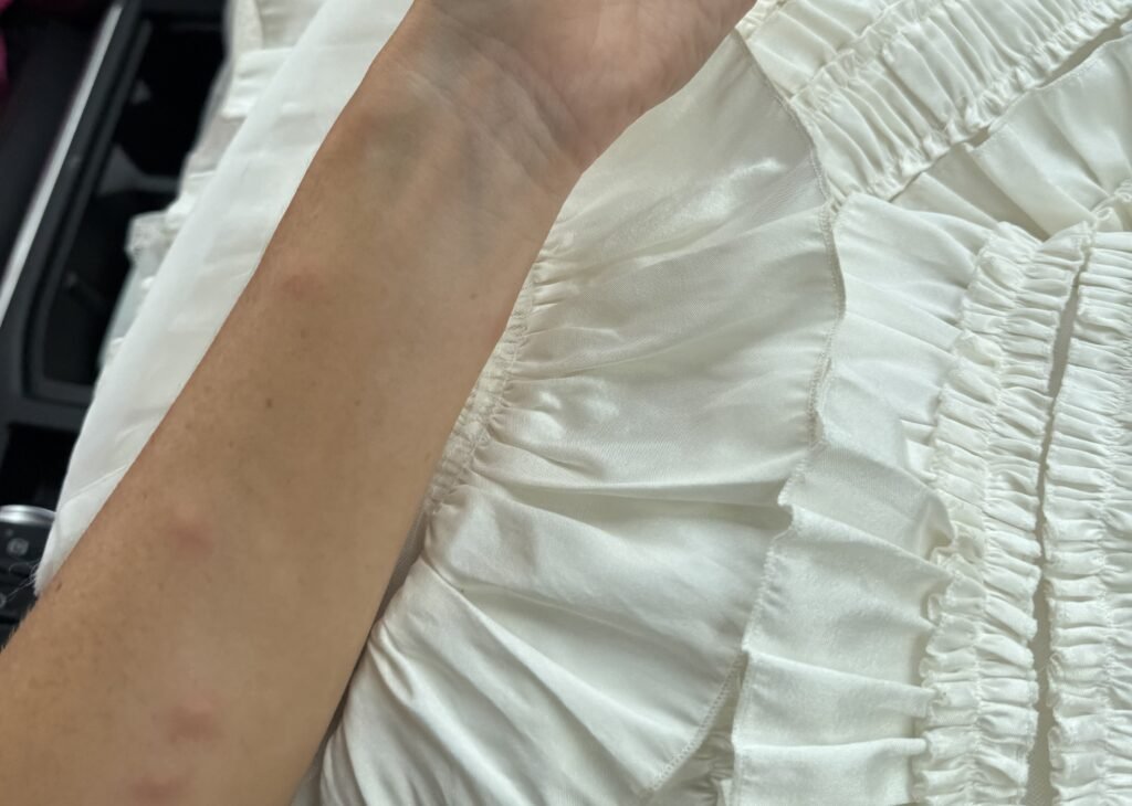 Bride woke up covered in more than 50 swollen mosquito bites on her wedding day after sleeping with the doors open when the air conditioning broke at her Mallorca accommodation.