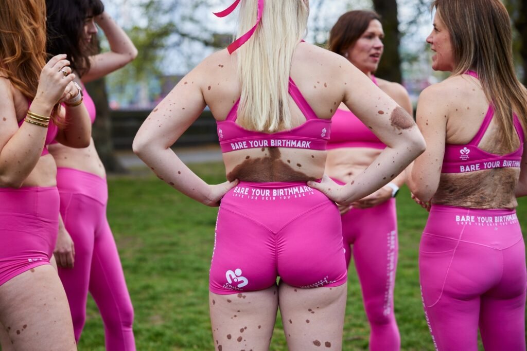 Woman covered in birthmarks across up to 80% of her body reveals people sometimes ask if she's 'fallen over in mud' - but says she 'embraces' being different rather than hiding it.