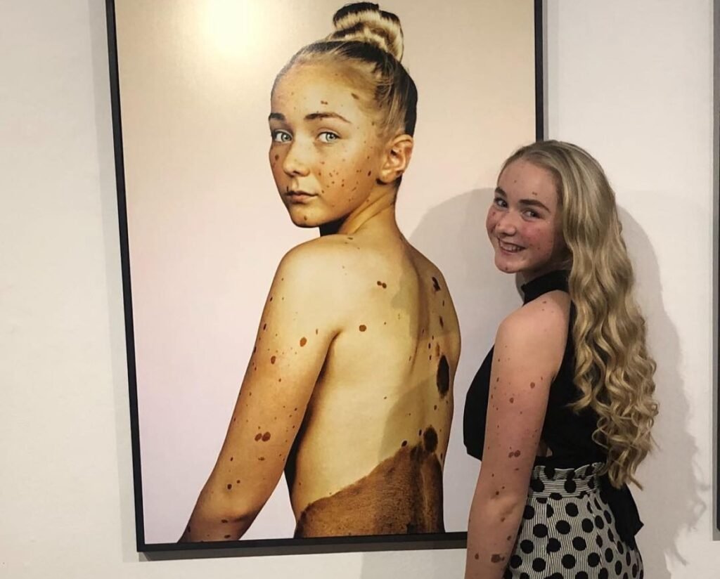 Woman covered in birthmarks across up to 80% of her body reveals people sometimes ask if she's 'fallen over in mud' - but says she 'embraces' being different rather than hiding it.