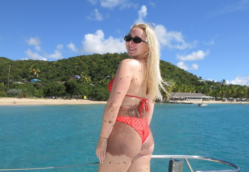 Woman covered in birthmarks across up to 80% of her body reveals people sometimes ask if she's 'fallen over in mud' - but says she 'embraces' being different rather than hiding it.