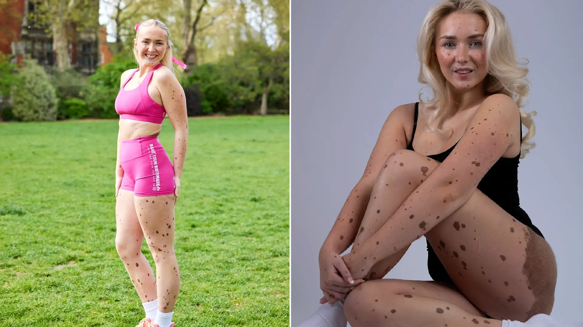 Woman covered in birthmarks across up to 80% of her body reveals people sometimes ask if she's 'fallen over in mud' - but says she 'embraces' being different rather than hiding it.