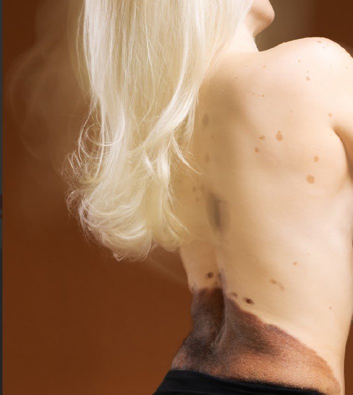 Woman covered in birthmarks across up to 80% of her body reveals people sometimes ask if she's 'fallen over in mud' - but says she 'embraces' being different rather than hiding it.