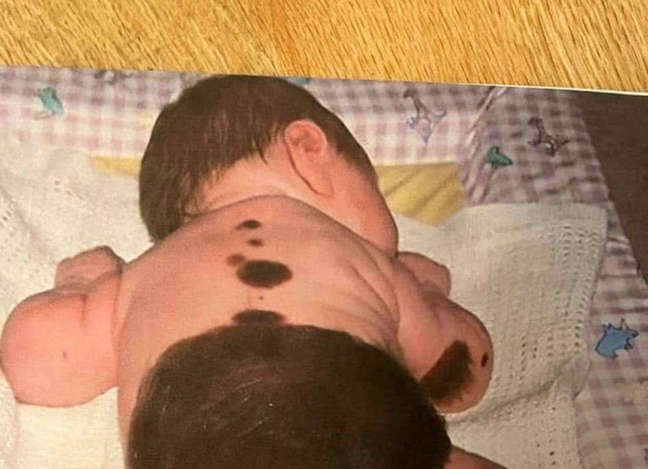 Woman covered in birthmarks across up to 80% of her body reveals people sometimes ask if she's 'fallen over in mud' - but says she 'embraces' being different rather than hiding it.