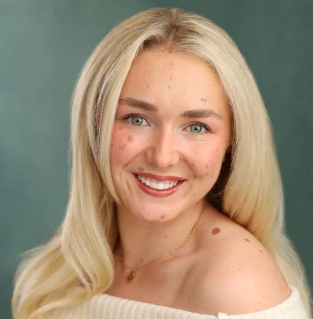 Woman covered in birthmarks across up to 80% of her body reveals people sometimes ask if she's 'fallen over in mud' - but says she 'embraces' being different rather than hiding it.