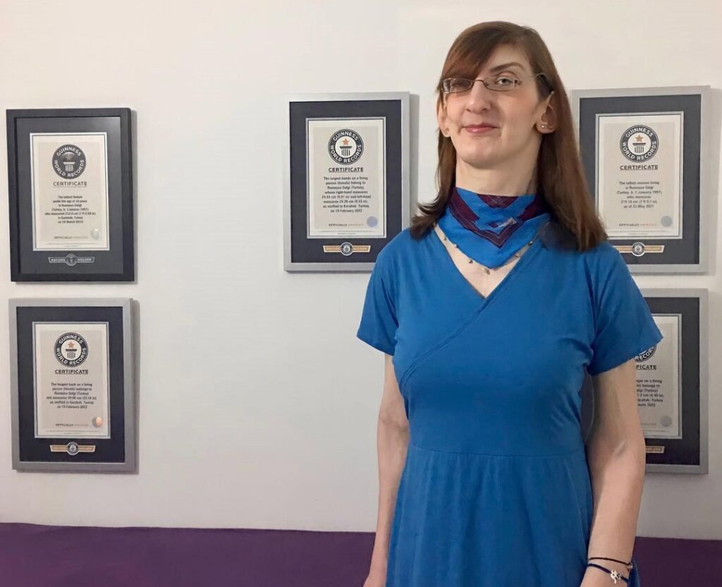 World's tallest woman told her lifelong diagnosis was wrong at 29 - she is now one of just six known cases of a mystery condition with no known cause.