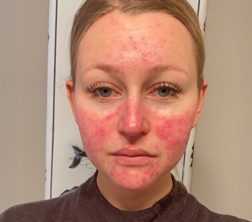 A woman's pregnancy acne got so painful she couldn't smile and would only see her boyfriend in the dark - until a £200 four-step routine cleared her skin.