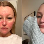 A woman's pregnancy acne got so painful she couldn't smile and would only see her boyfriend in the dark - until a £200 four-step routine cleared her skin.