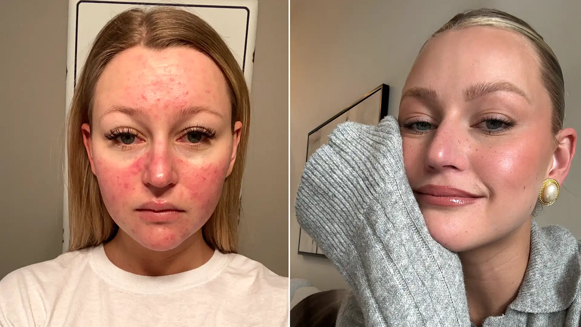 A woman's pregnancy acne got so painful she couldn't smile and would only see her boyfriend in the dark - until a £200 four-step routine cleared her skin.