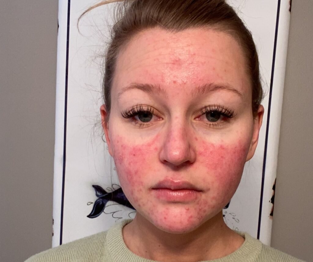 A woman's pregnancy acne got so painful she couldn't smile and would only see her boyfriend in the dark - until a £200 four-step routine cleared her skin.