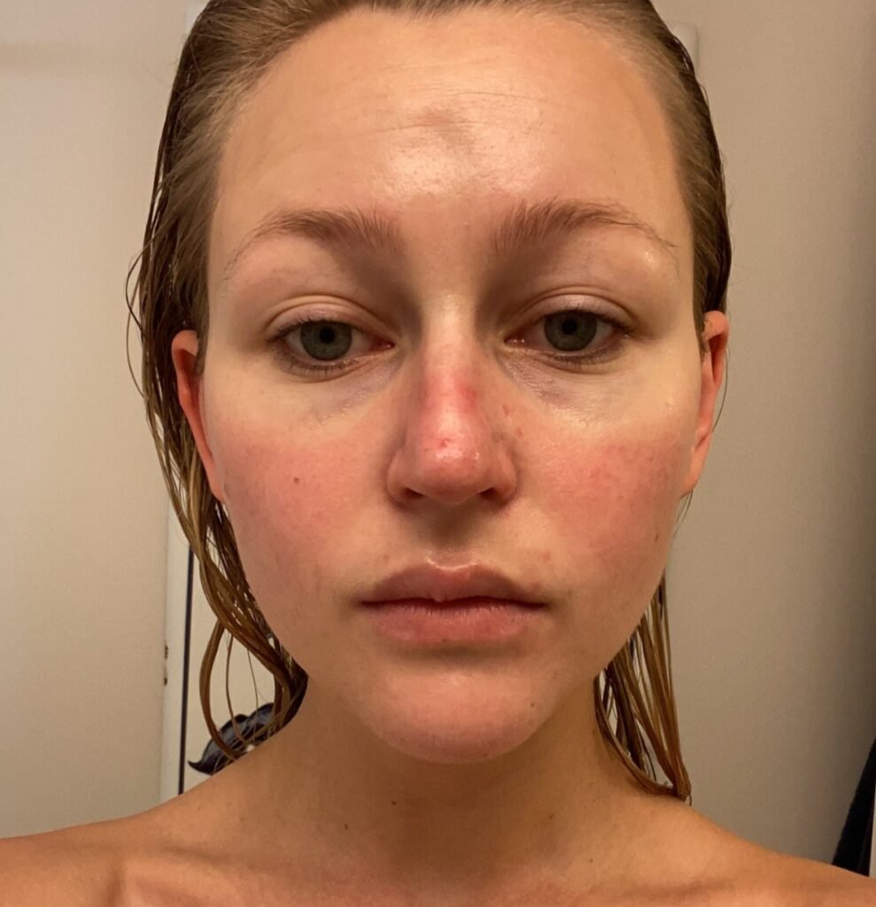 A woman's pregnancy acne got so painful she couldn't smile and would only see her boyfriend in the dark - until a £200 four-step routine cleared her skin.