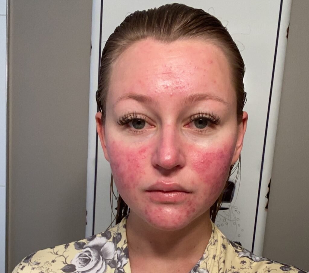 A woman's pregnancy acne got so painful she couldn't smile and would only see her boyfriend in the dark - until a £200 four-step routine cleared her skin.