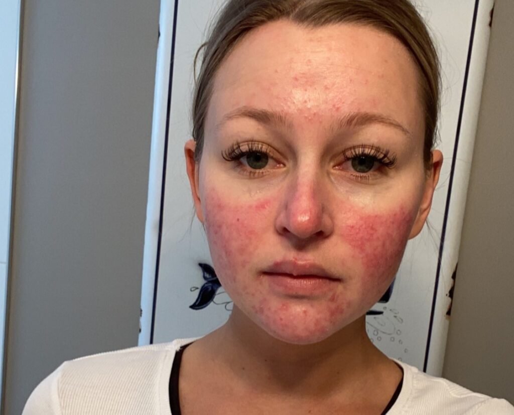 A woman's pregnancy acne got so painful she couldn't smile and would only see her boyfriend in the dark - until a £200 four-step routine cleared her skin.