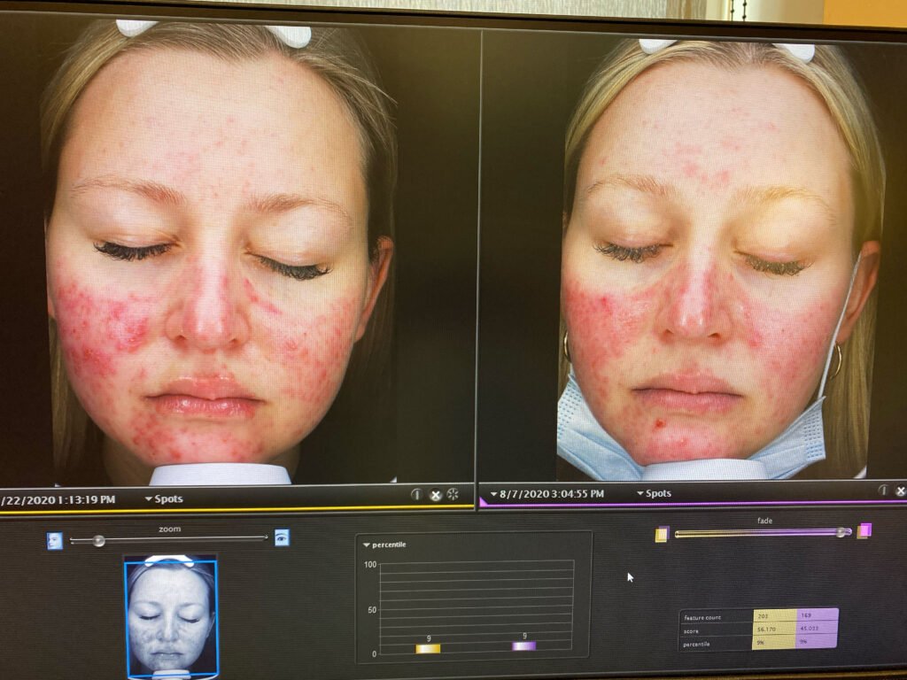A woman's pregnancy acne got so painful she couldn't smile and would only see her boyfriend in the dark - until a £200 four-step routine cleared her skin.