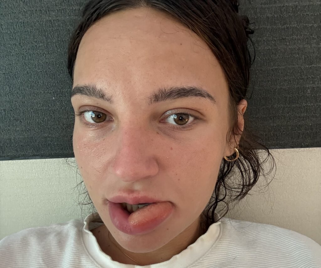 A woman woke to find her lip had ballooned after she chewed it in her sleep, leaving her looking "like she'd been stung by a bee" - just hours before a visa run.