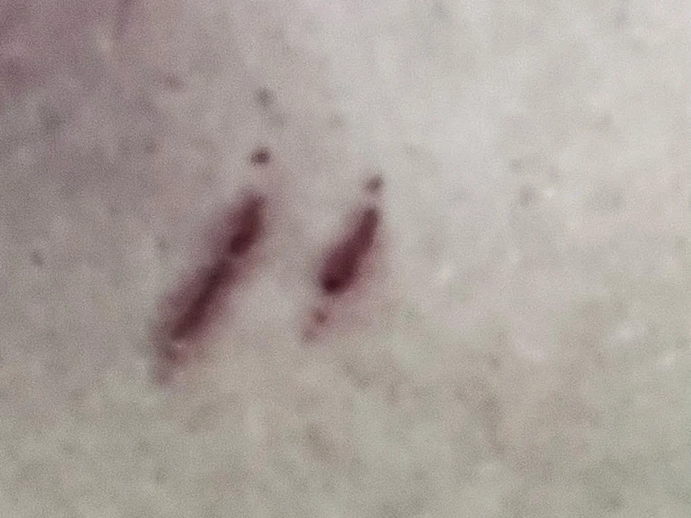 Deep purple scratch marks visible on pale human skin on back area